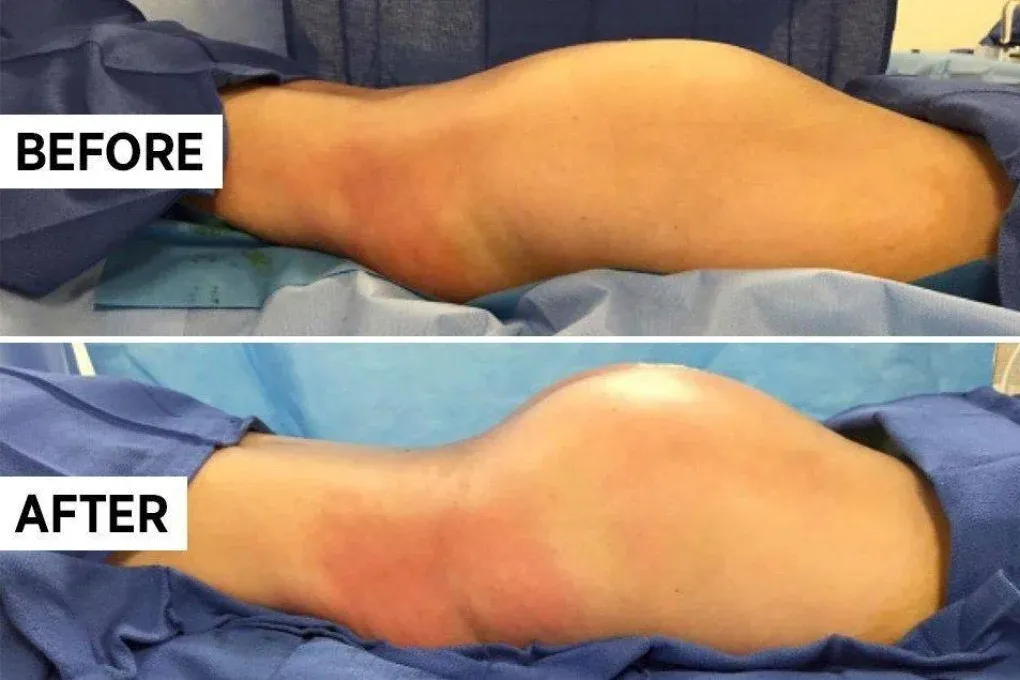 Brazilian butt lift before and after