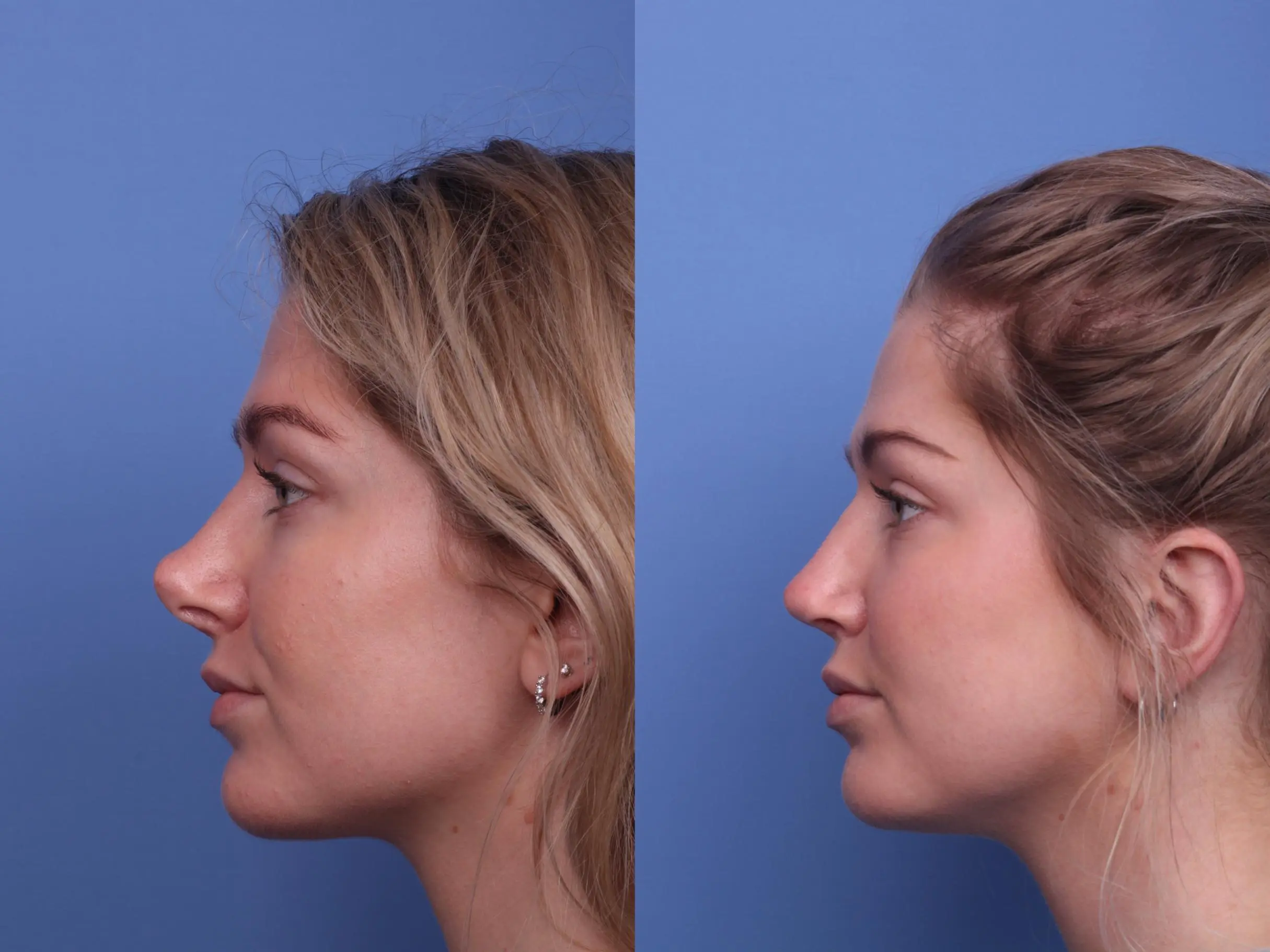 Rhinoplasty - the before and after